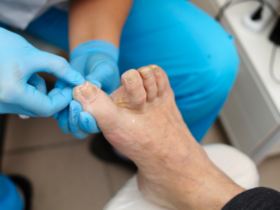 Podolog Piotr Barchan w swoim gabinecie podologicznym dokonuje przeglądu stopy starszej pacjentki z chorobą grzybiczą - grzybica stopy oraz grzybica paznokci.